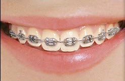 What Are Elastics for Braces? - Northenden House Orthodontics